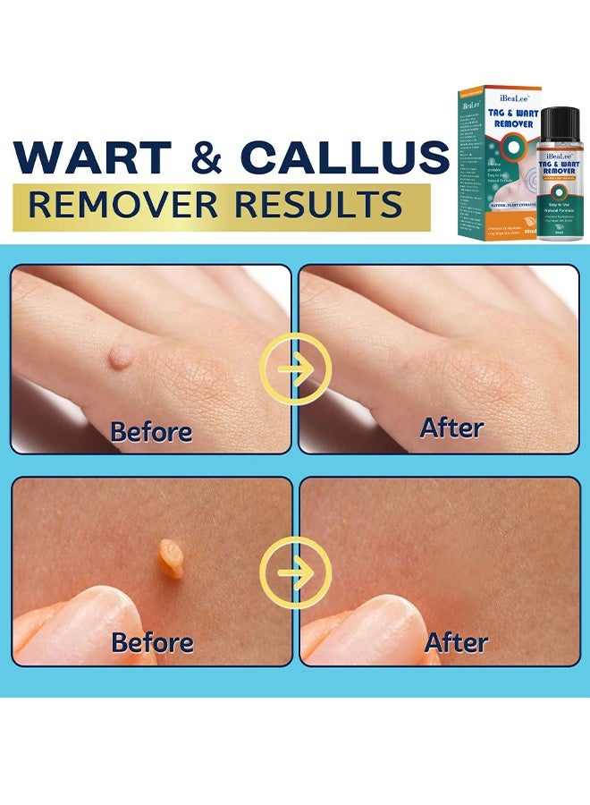 iBealee Natural & Safe Wart And Mole Remover Liquid, Wart Remover Liquid, Salicylic Acid Fast-Acting Formula For Plantar Warts, Skin Tags, Corns & Callus Removal, Pain-Free Scar-Free Treatment, Toes & Foot Care For Men & Women, 20ml - Image 5